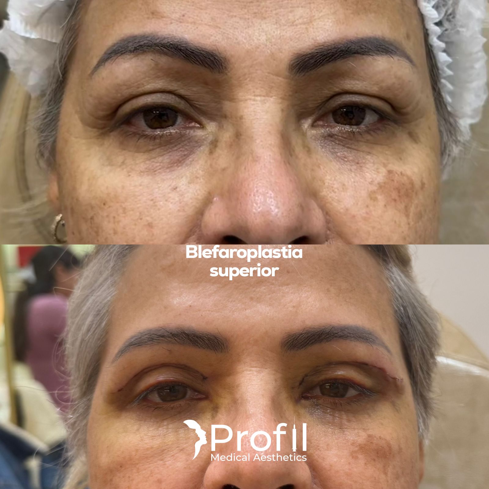 Blefaroplastia Superior