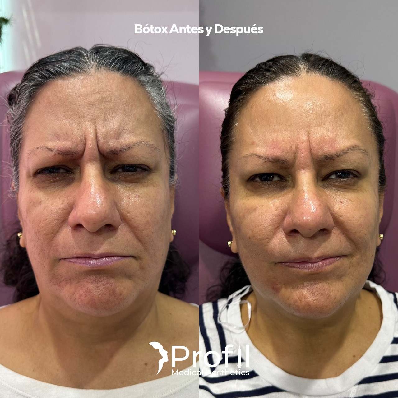 Botox