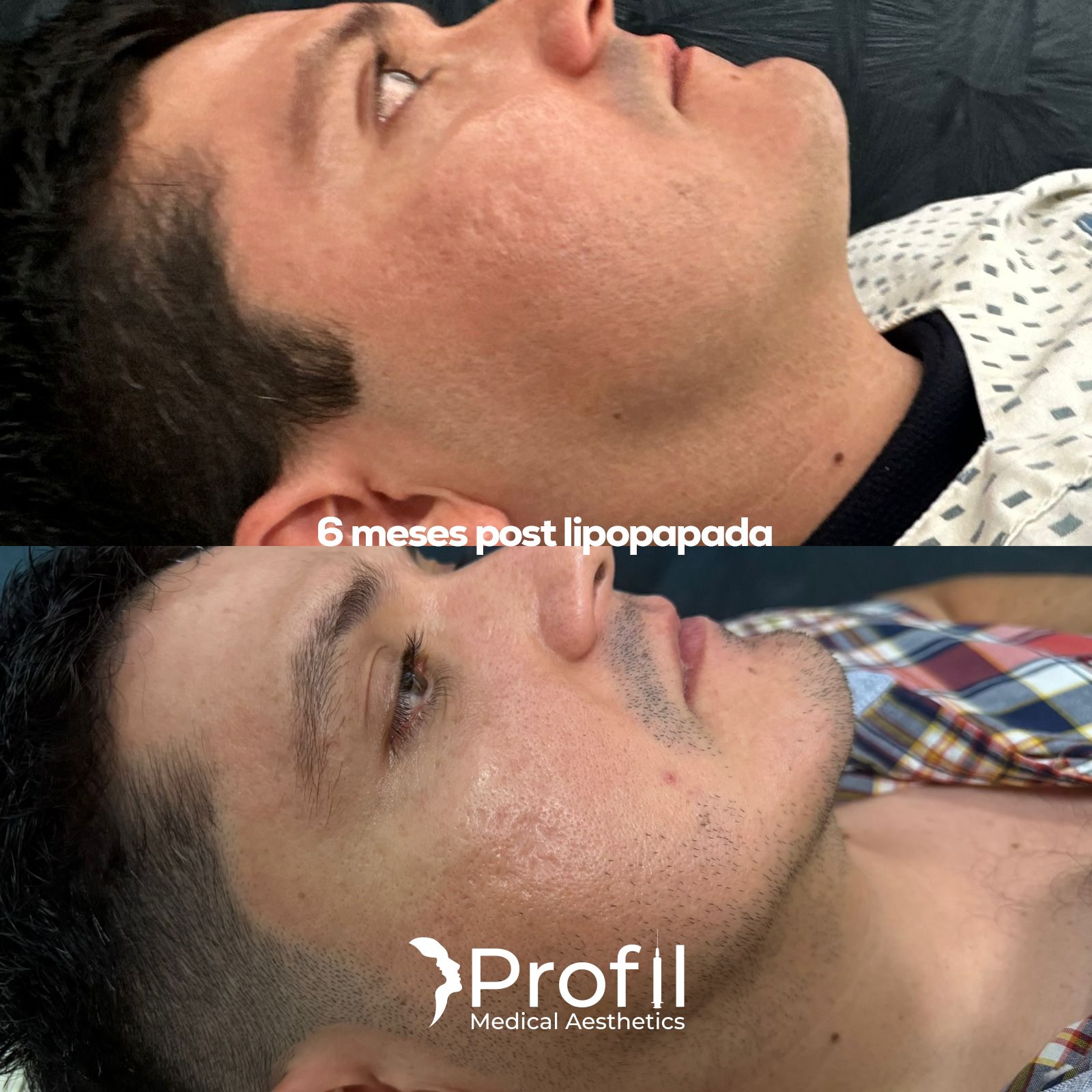 Lipopapada