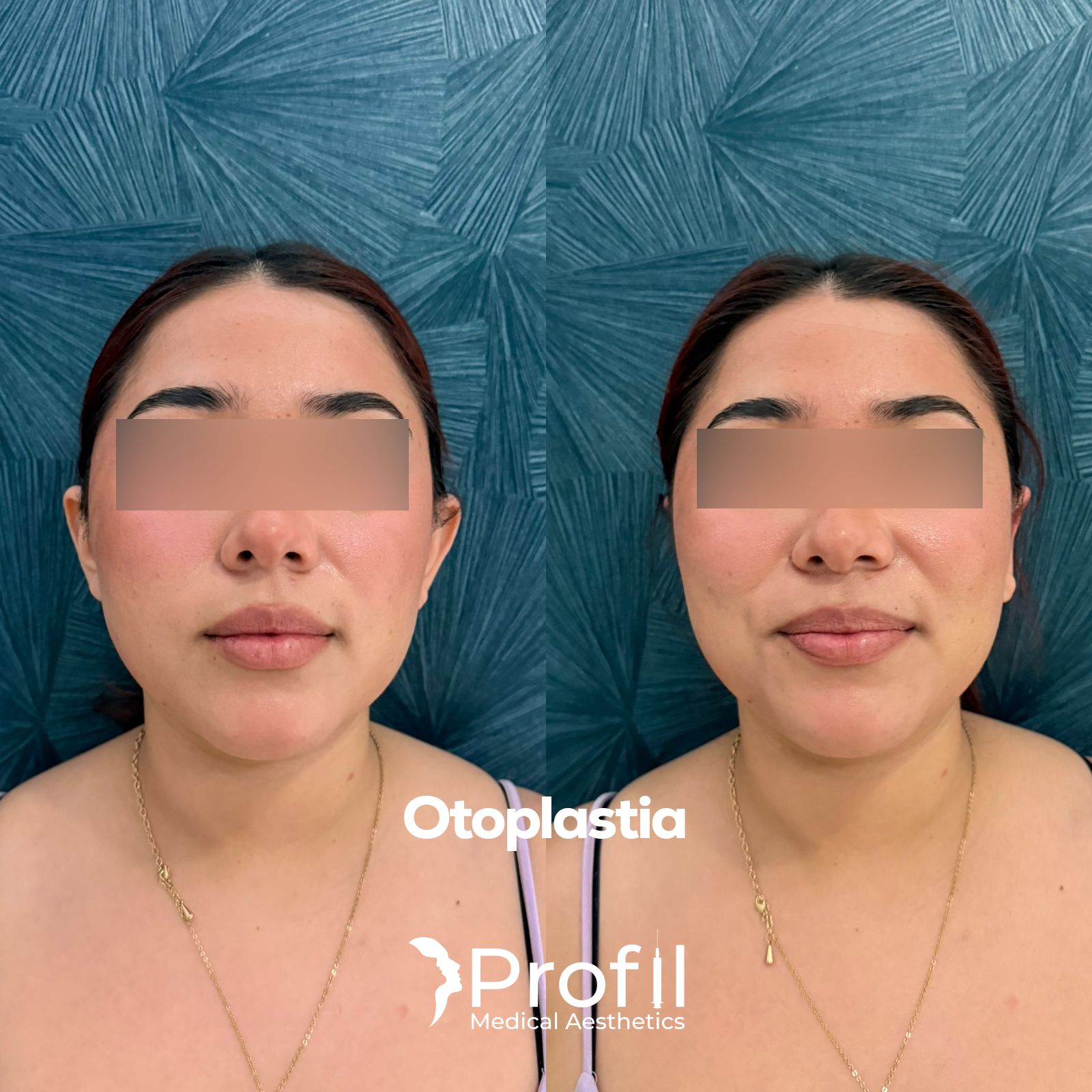 Otoplastia