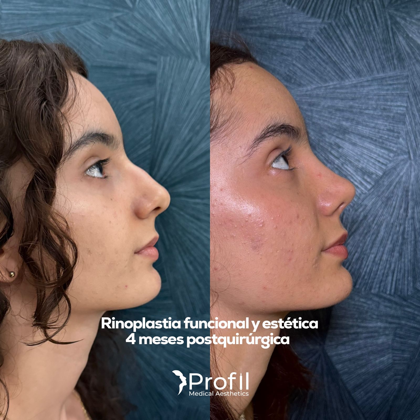 Rinoplastia Funcional y Estética