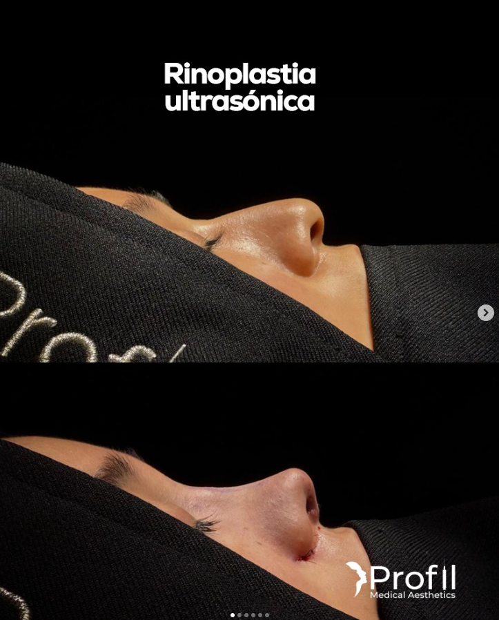 Rinoplastia Ultrasónica